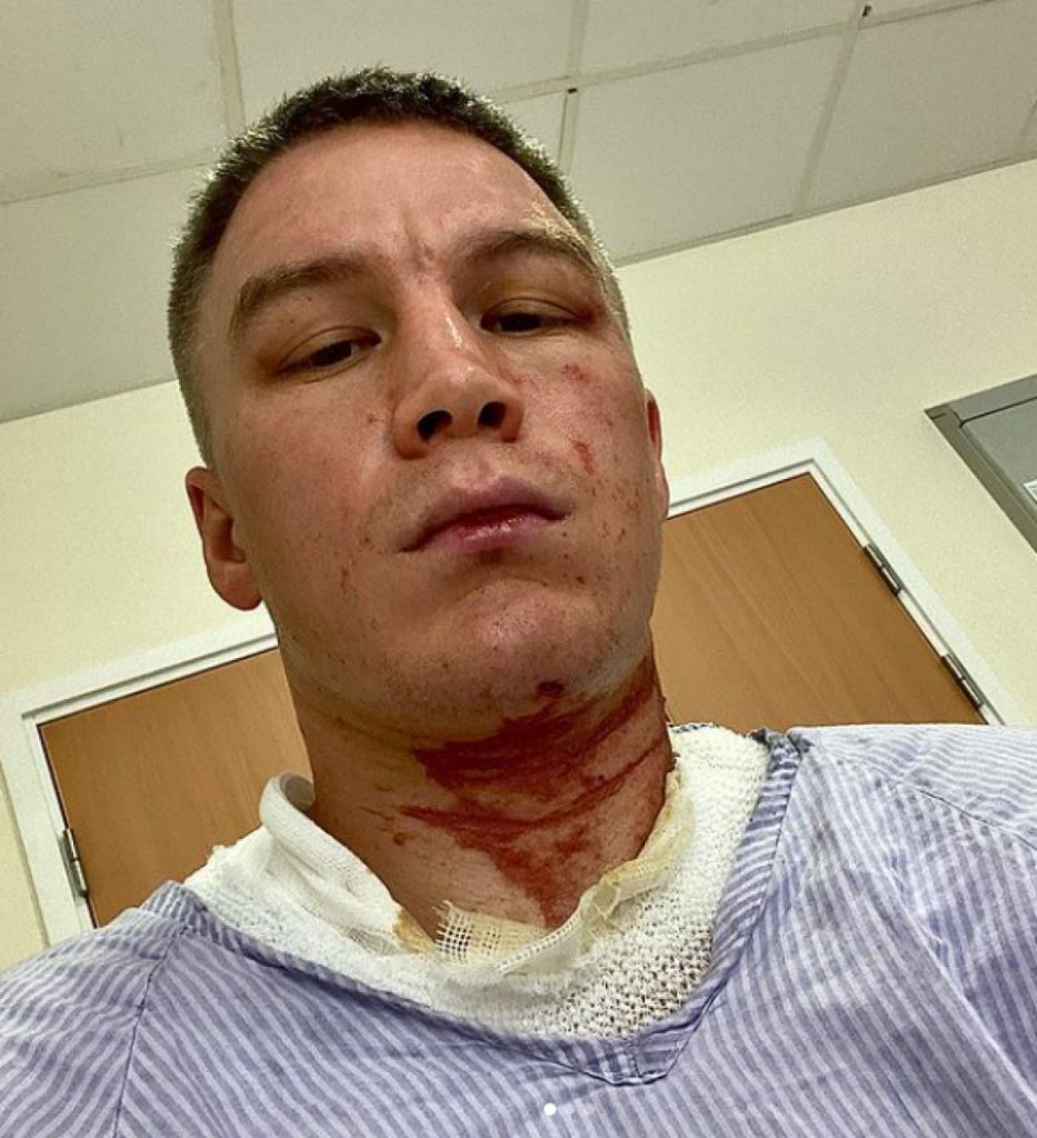 Boxer profesionist, atacat cu acid în Anglia. L-au desfigurat